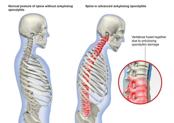 Ankylosing-Spondylitis