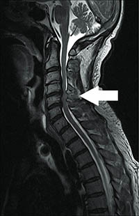 compressive-myelopathy